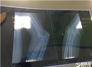 騎行小米九號平衡車摔骨折 官方回應：雨后路滑