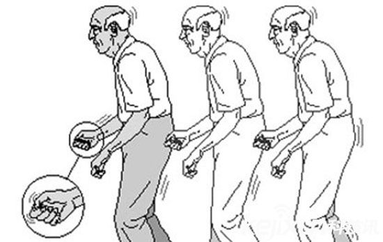 智能穿戴在醫學上的擴展 帕金森癥用智能穿戴緩解