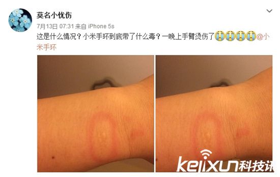 小米手環(huán)燙傷用戶? 真假難辨誰之過