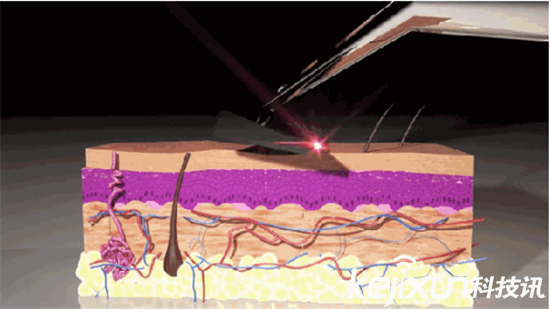 激光剃須刀: 無需換刀頭 每天享受干凈臉容