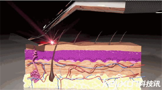 激光剃須刀: 無需換刀頭 每天享受干凈臉容